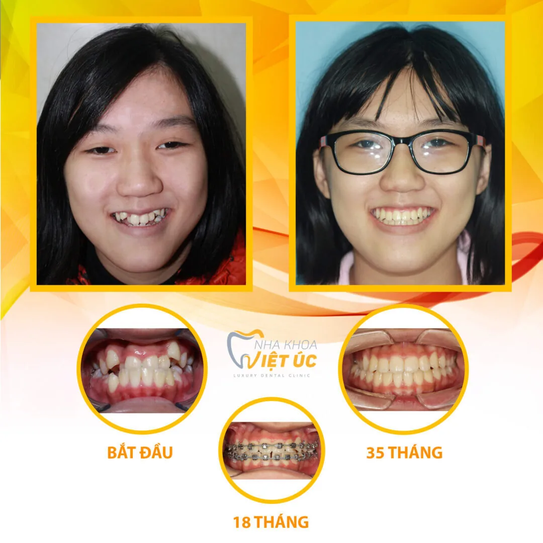 Hình ảnh bệnh nhân Phương Linh sau khi kết thúc quá trình niềng răng