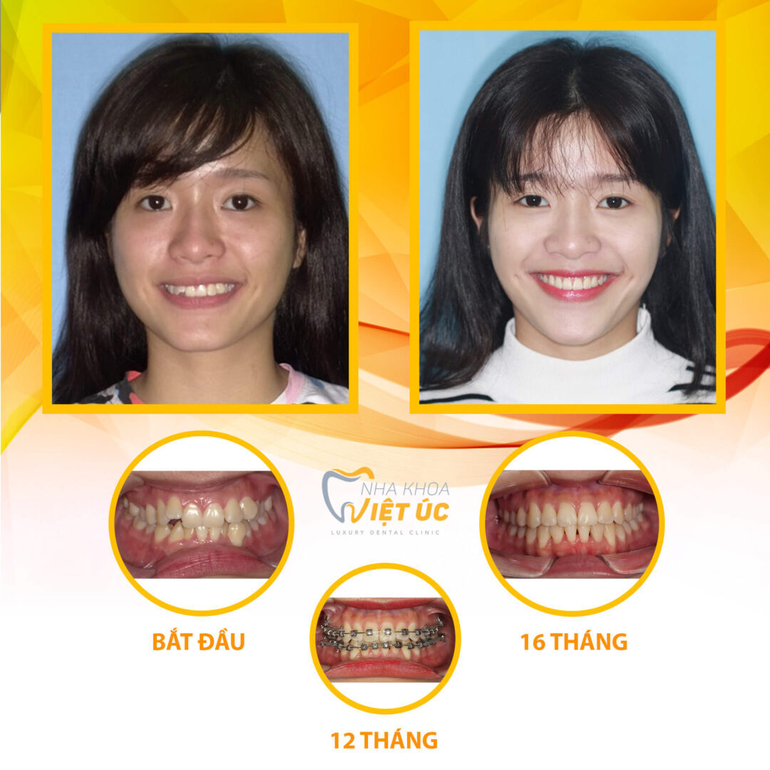 Hình ảnh bệnh nhân sau khi kết thúc quá trình niềng răng