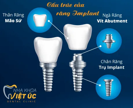 Trồng răng Implant I-tech có răng trong ngày
