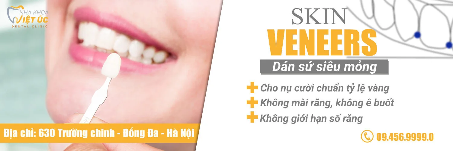 Dán sứ Veneer toàn hàm