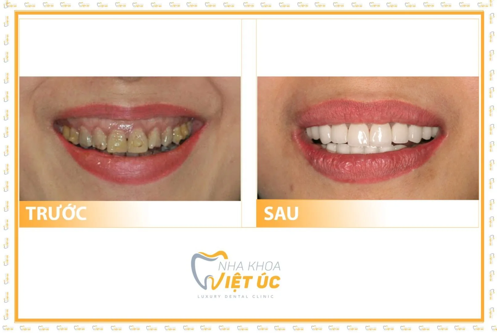 Dan rang su Veneer
