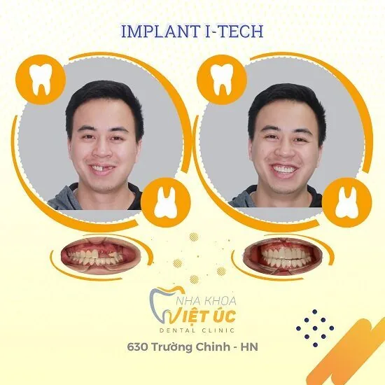 trong rang Implant