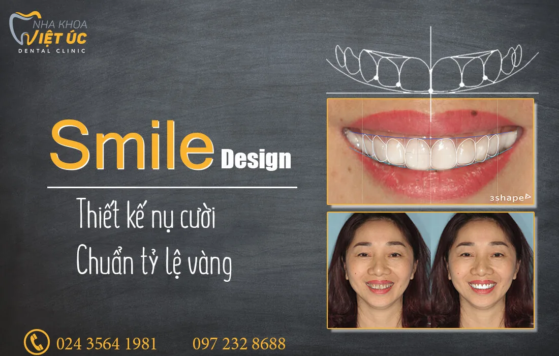 dan rang su Veneer