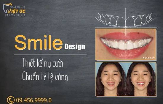 thiet-ke-nu-cuoi-nha-khoa-viet-uc-nho