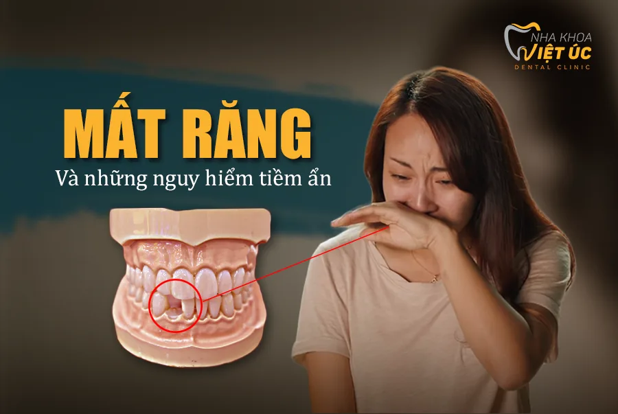 cay ghep rang Implant de giam tac hai cua mat rang
