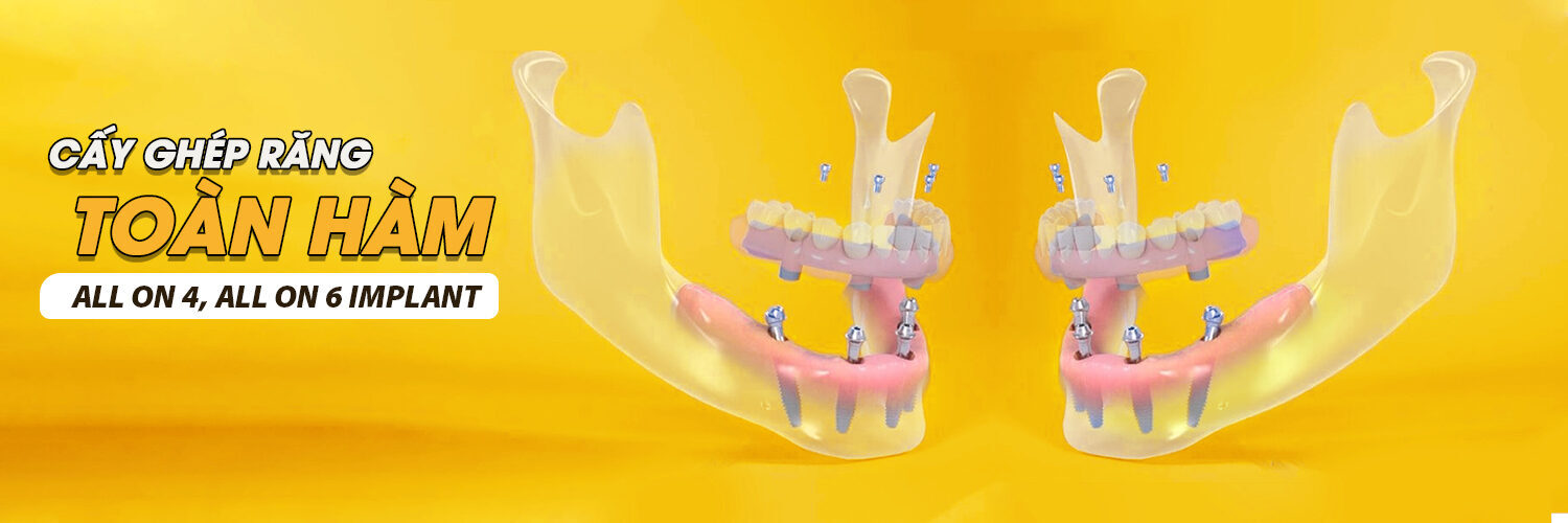 Trồng răng Implant All on 4, All on 6