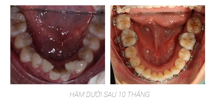 Kinh nghiem sau 10 thang nieng rang