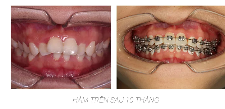 Kinh nghiem sau 10 tháng niềng răng