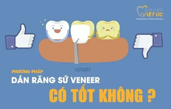 dan rang su veneer co tot khong
