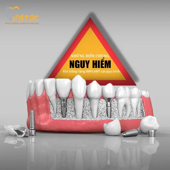 hau qua cua viec trong rang Implant sai cach