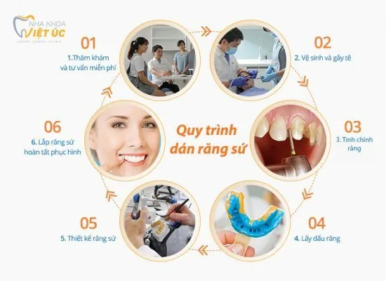 quy trinh dan su veneer