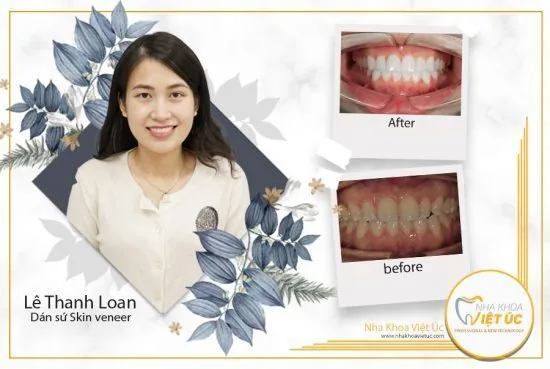 dan su skin veneer