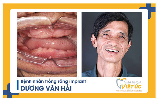 Quy trình trồng răng Implant tại nha khoa Việt Úc