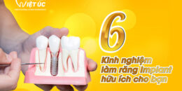 Chia sẻ kinh nghiệm làm răng Implant cho người bị mất răng