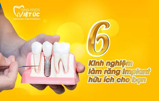 Kinh nghiem lam rang implant