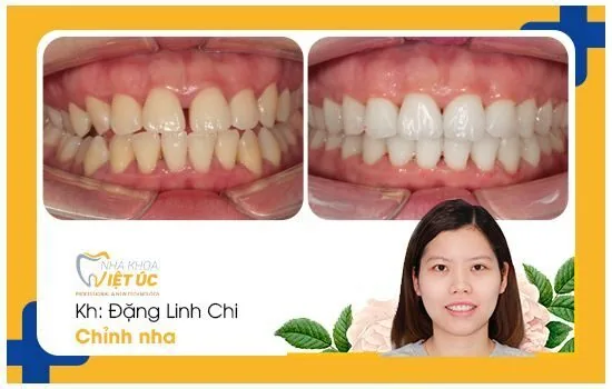 Niềng răng đem lại một hàm răng đều đẹp