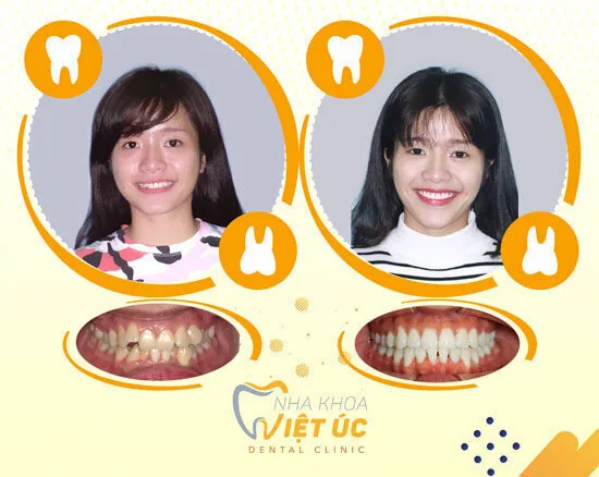 anh-truoc-sau-nieng-rang-mac-cai