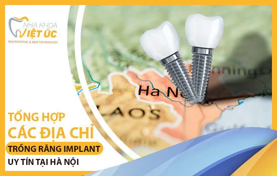 dia chi trong rang Implant tai Ha Noi