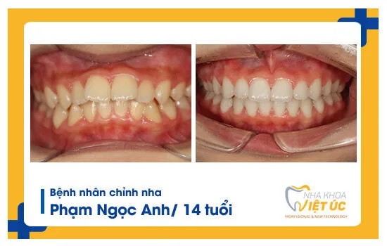 do-tuoi-nieng-rang