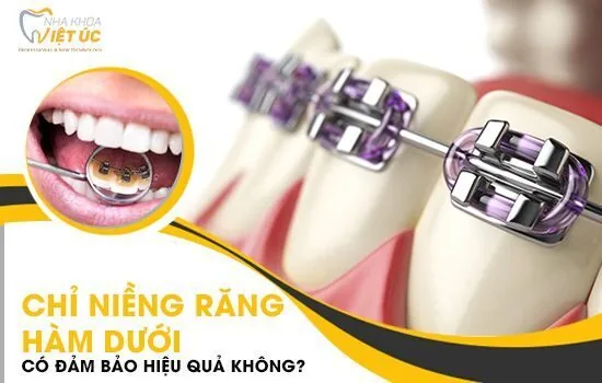 Niềng răng hàm dưới 