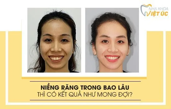 Niềng răng trong bao lâu để đạt hiệu quả tốt?
