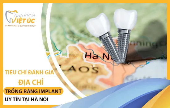 tieu chi danh gia dia chi trong rang Implant uy tin tai Ha Noi