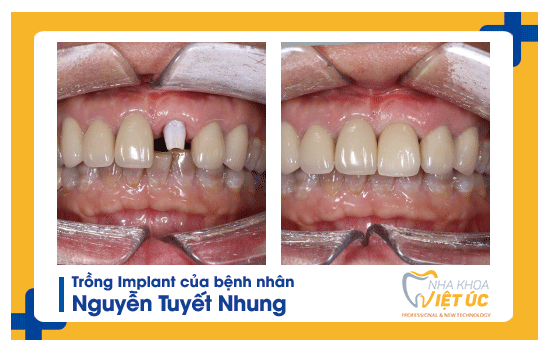 Khách hàng trồng răng Implant tại nha khoa Việt Úc