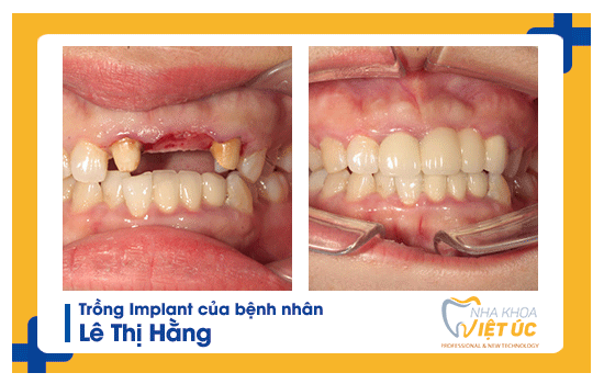 Khách hàng trồng răng Implant tại nha khoa Việt Úc