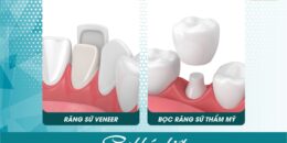 Sự khác biệt của răng sứ Veneer và bọc răng sứ thẩm mỹ