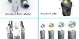 Tổng hợp và so sánh 5 loại trụ Implant tốt nhất hiện nay
