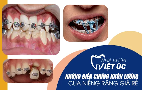 bien-chung-nieng-rang-gia-re