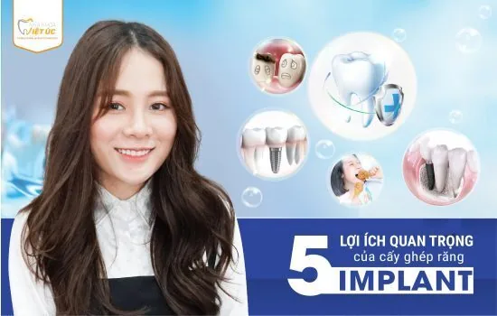 5 lợi ích quan trọng của cấy ghép răng Implant-01