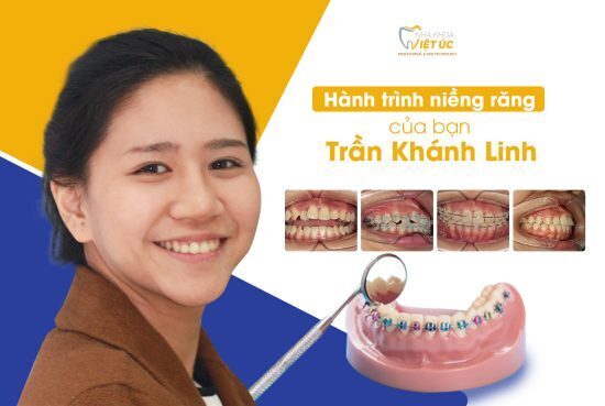Hành trình niềng răng của bạn Trần Khánh Linh