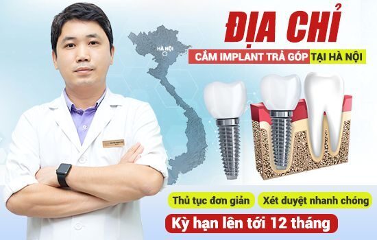 dia-chi-cam-implant-tra-gop-tai-ha-noi