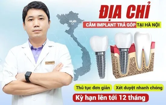 dia-chi-cam-implant-tra-gop-tai-ha-noi