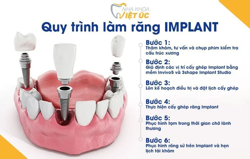 cac buoc trong rang Implant