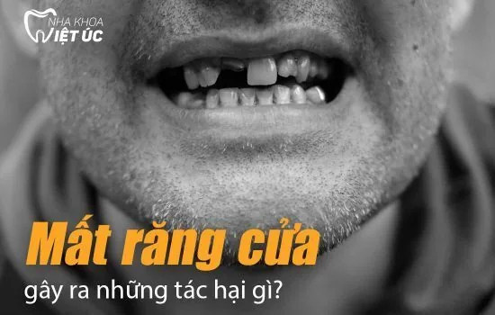 Mất răng cửa