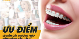Niềng răng mắc cài sứ có ưu điểm gì đặc biệt?