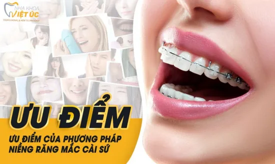 Niềng răng mắc cài sứ có ưu điểm gì đặc biệt?