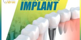 Cần kiêng gì sau khi cắm Implant để đạt hiệu quả tốt nhất?