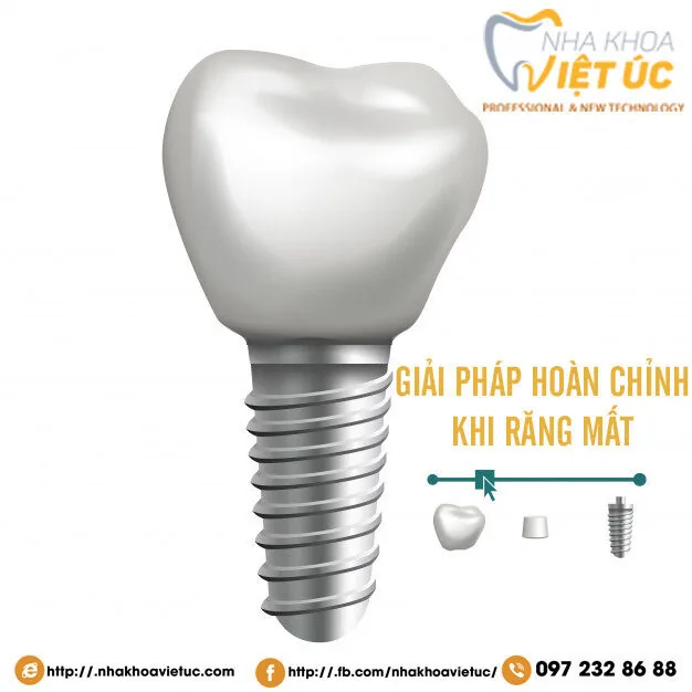 dental-implant-illustration_87720-2754