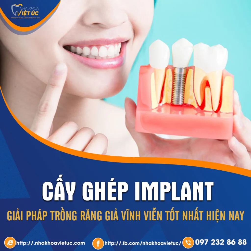 implant tốt nhất hiện nay