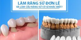 Làm răng sứ đơn lẻ và làm cầu răng sứ có gì khác biệt?