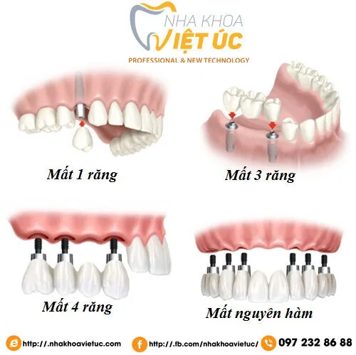cac-truong-hop-cay-ghep-rang-implant