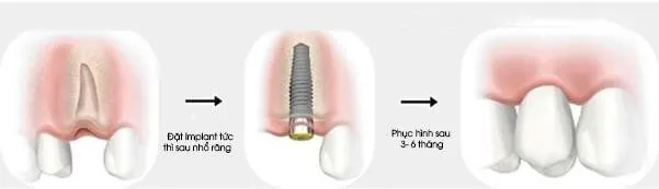 dat-implant-sau-khi-nho-rang