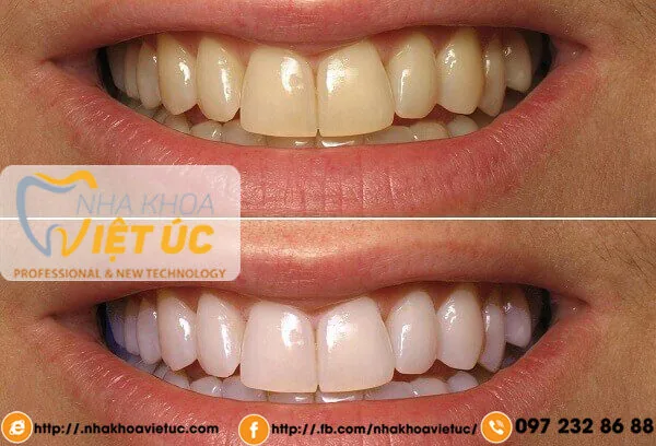 quy-trinh-tay-trang-rang-1_fc4f9ce1f29440f38633e6316fd58ed5_grande