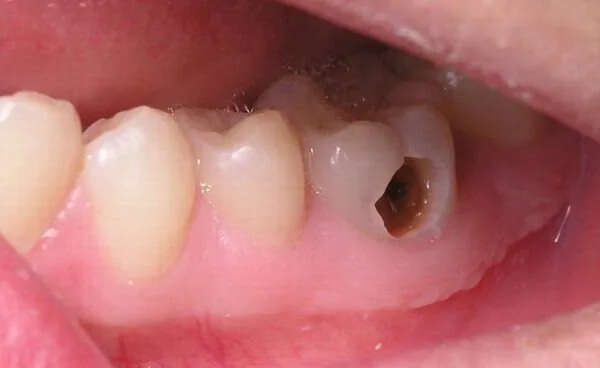 rang-chet-tuy-1