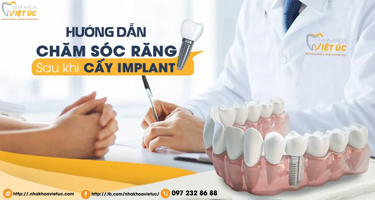 hướng dẫn chăm sóc răng implant sau khí trồng