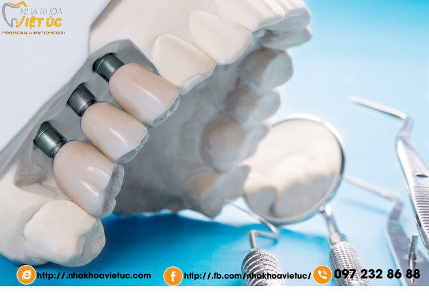 close-up-implant-model-tooth-support-fix-bridge-implant-crown_60829-668