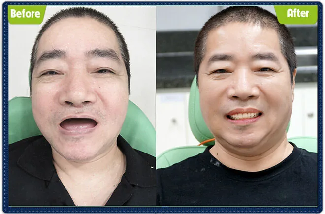 Cuu-chien-binh-mat-rang-toan-ham-thay-11-bo-rang-trong-20-nam-xx-1522723462-367-width660height435